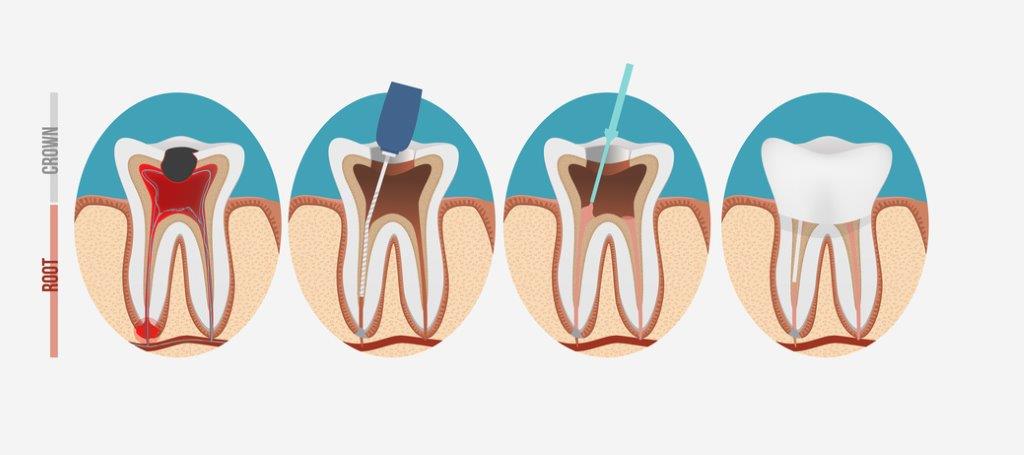 Figura que muestra un proceso de endodoncia