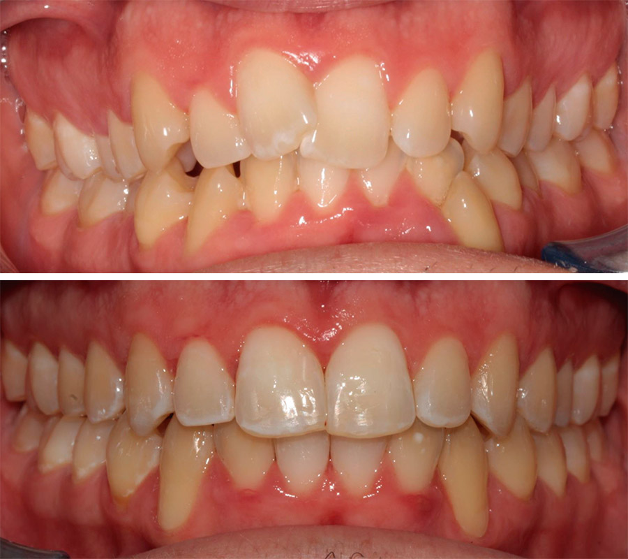 Imagen de una ortodoncia invisible, con vista frontal de la dentadura, antes y después