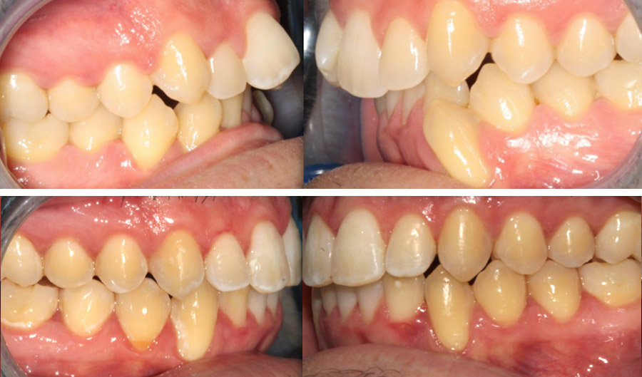 Imagen de una ortodoncia invisible, con vistas laterales de la dentadura, antes y después