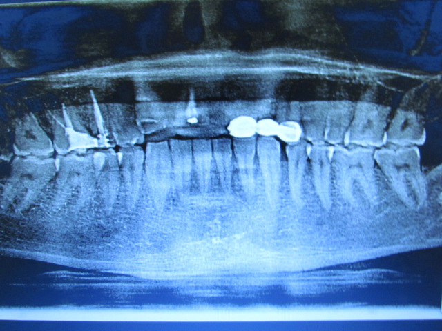 Imagen de radiografía de la boca en mal estado antes de realizarse puente sobre implantes de cerámica