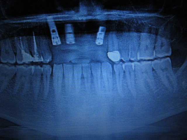 Imagen de radiografía de la boca después de realizarse puente sobre implantes de cerámica